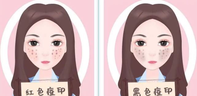 臉上紅色痘印幾個(gè)月都不消怎么辦？紅色痘印應(yīng)該怎么消除？
