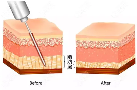 抽脂手術(shù)對(duì)身體有什么傷害？該不該禁止抽脂手術(shù)？